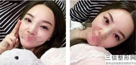 2022年北京鼻翼缩小整容医院榜单!北京伊美康整形美容医院(公立私立均有)