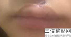 2022年北京玻尿酸丰唇珠整容整形医院排行榜！北京大学第三医院鹤立鸡群