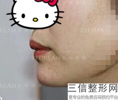 2022年北京玻尿酸注射丰唇术整形美容医院排名！北京京城皮肤病医院榜上有名