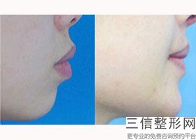 2022年北京玻尿酸注射丰唇整容医院前三名！北京王磊医疗美容诊所望尘莫及