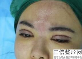 2022年北京玻尿酸注射眉弓整形医院榜单!北京同仁医院眼整形科公立口碑好、技术专业、价格合理