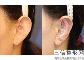 2022年北京菜花耳矫正医院排名前三位！北京印正山医疗美容诊所公立5强擅长口碑各不同~价格表请查收