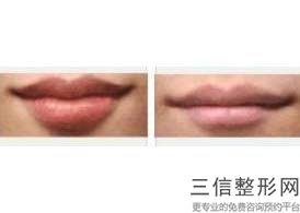 2022年北京唇部矫正整形医院排名前三！北京画美医疗美容医院排名靠前