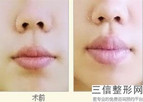 2022年北京唇腭裂手术整形医院三大排名！北京凯尔医院锁定前三