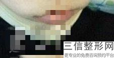 2022年北京唇裂修复术整形医院榜单前三！北京金凤凰整形美容医院遥遥领先