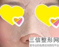 2022年北京达拉斯综合美鼻美容医院前三！空军总医院激光整形美容中心不看后悔！