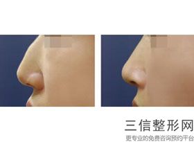2022年北京垫鼻基底失败修复整形医院排名前三！北京爱悦丽格医疗美容排名靠前