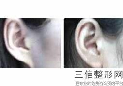 2022年北京耳廓畸形矫正整形美容医院排名！北京加减美(国际)整形美容医美三强口碑擅长各不同