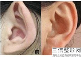 2022年北京丰耳垂整容整形医院排行榜!北京知音医疗美容门诊部有限公司价格表权威一览!