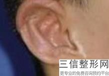 2022年北京副耳切除整容医院前三位！北京天使名源医疗美容诊所有各医院收费价格明细哟