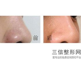 2022年北京刮痧治疗酒渣鼻美容整形医院哪家好？北京八大处整形外科医院私立医美3强优质口碑医院推荐