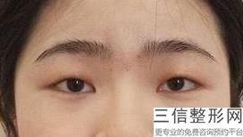 2022年北京硅胶垫眉弓整形医院评价！北京凯尔医院等荣誉上榜！价格收费可查！