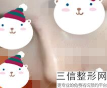 2022年上海超高鼻尖矫正术整形医院排名前三！上海新极点医疗美容诊所再次蝉联前三甲_价格表爆出