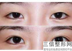 2022年上海超声袪除黑眼圈术整形医院评价！上海银城医疗美容门诊部鼎鼎大名