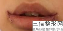 2022年上海唇颊部缺损修复术整形医院有哪些？上海伊莱美医疗美容医院2022价格表清单透明！