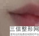 2022年上海唇裂继发畸形修复整容医院榜单！上海新极点医疗美容诊所鼎鼎大名