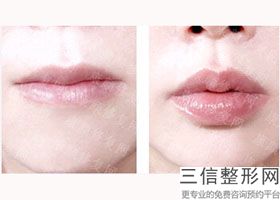 2022年上海唇珠成型整形医院选择？上海交通大学医学院附属第九人民医院浦东分院驰名中外