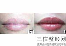 2022年上海唇珠成形术整容医院榜单！上海韩镜医疗美容医院排行榜前五强权威汇总盘点！