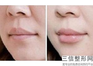 2022年上海唇珠唇峰美容整形医院排名！上海联合丽格医疗美容门诊部再次蝉联前三甲_价格表爆出