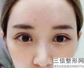 2022年上海定点双眼皮美容整形医院哪家好？上海联合丽格医疗美容门诊部不看后悔！