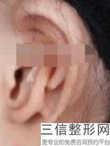 2022年上海耳垂修复整容医院排名！上海赛美瑞医疗美容门诊部公布3家当地有名气价格也实惠!