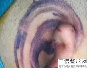 2022年上海耳软骨隆鼻尖美容整形医院排名!上海中山医院整形外科声名远扬
