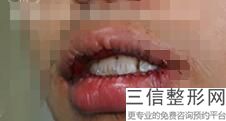 2022年上海丰唇美容整形医院哪家好？上海虹桥医院价格优惠在线了解！