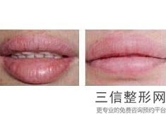 2022年上海丰唇术整容医院前三名!上海美立方医疗美容医院位列前三
