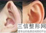 2022年上海丰耳垂整容医院榜单！上海澳雅医疗美容门诊部都是私立机构入围_附价格费用参考