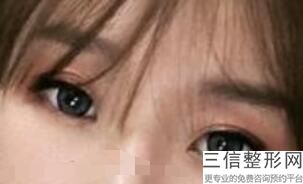 2022年上海缝线法割双眼皮整形医院三大排名！上海美赋医疗美容门诊部2022价格优惠情况！
