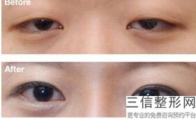 2022年上海割眼袋整形美容院榜单！上海薇琳医疗美容医院价格优惠在线了解！