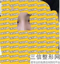 2022年上海骨膜下隆鼻整形医院榜单！上海港华医院公立口碑好、技术专业、价格合理
