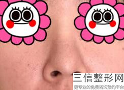 2022年上海刮痧治疗酒糟鼻美容整形排行榜！上海伊莱美医疗美容医院鼎鼎大名