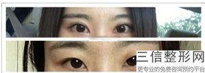 2022年上海硅胶丰眉弓整形医院榜单前三！上海第二军医大学附属长海医院整形外科实力出众