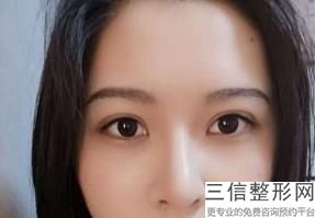 2022年上海韩式三点双眼皮整形医院有哪些？上海第二军医大学附属长海医院整形外科整形价格表