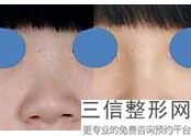 2022年上海韩式驼峰鼻矫正医院怎么选择？上海中医医院看排名榜中公私立医院相互比拼！