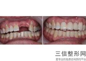 2022年上海合金烤瓷牙整形医院前三！上海复美医疗美容门诊部锁定前三