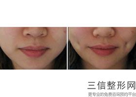 2022年上海厚唇变薄术整容医院榜单！上海百达丽医疗美容门诊部口碑不错