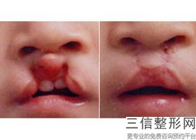 2022年上海厚唇变薄术整形医院榜单！上海仁爱医院含新价格表收费标准