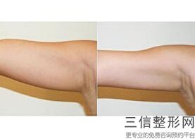 2022年上海激光溶脂瘦大腿整形医院排名前三！上海馥兰朵医疗美容门诊部价格收费同步！