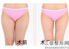 2022年上海激光溶脂瘦大腿整形医院有哪些？上海闵行中医医院等领衔三甲