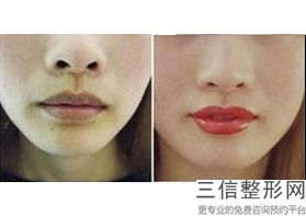 2022年上海激光脱唇毛整容整形医院排行榜！上海中山医院整形外科名闻遐迩