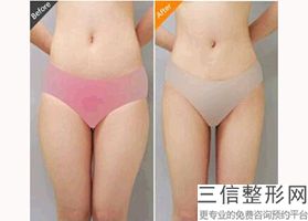 2022年上海激光吸脂瘦大腿整形医院三大排名！上海交通大学医学院附属仁济医院整形外科看排名榜中公私立医院相互比拼！