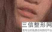 2022年上海继发唇裂修复整形美容医院排名!上海第一人民医院整形外科名列三甲