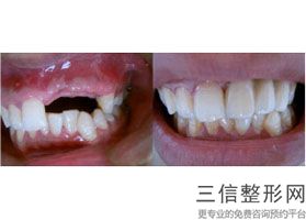 2022年上海矫正牙齿天包地整形医院排行榜！上海一美整形外科医院告诉你哪里的公立和私立好且实惠！