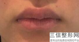 2022年上海胶原蛋白丰唇整形医院前三名！上海仁爱医院实力领衔（附价格表）
