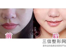 2022年上海胶原蛋白注射丰唇整形医院三大排名！上海澳雅医疗美容门诊部公立私立对比汇总
