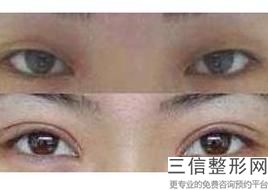 2022年上海胶原蛋白注射隆眉弓整形医院前三！上海澳雅医疗美容门诊部含价格一览表