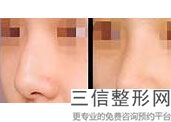 2022年上海酒糟鼻激光整容医院排名！上海沃德医疗中心领衔榜前三名