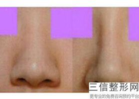 2022年上海宽鼻缩窄整形医院排名前三！上海新健威医疗美容门诊部技术点评_附价格一览表